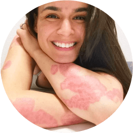 Sine lives with psoriasis